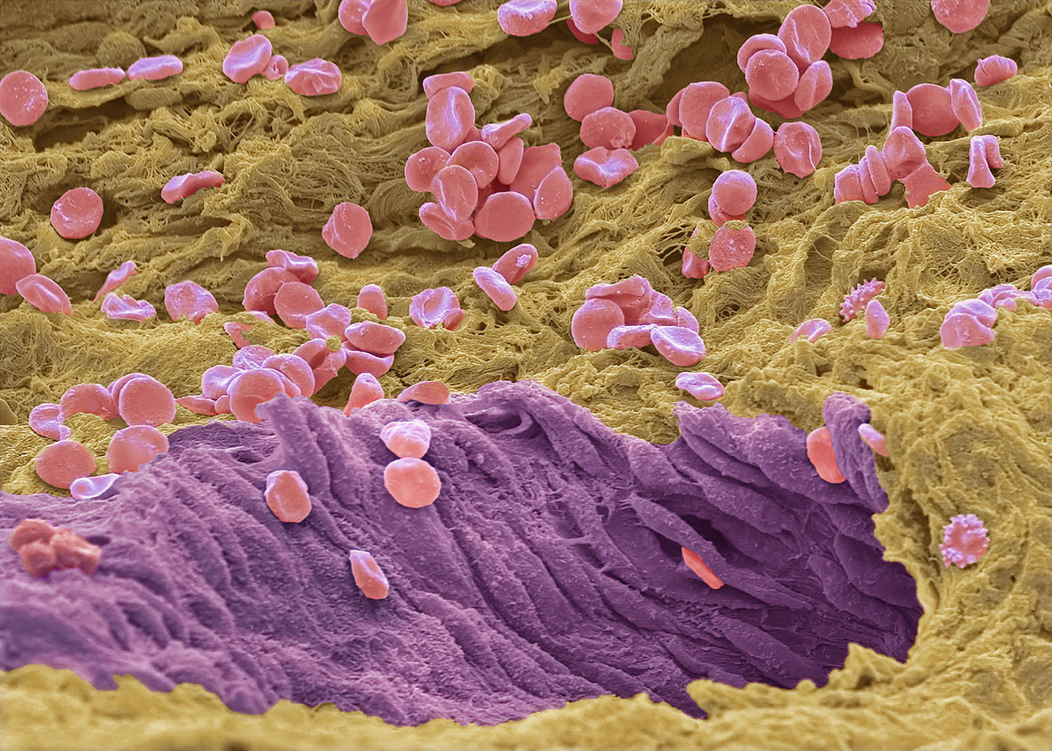 Farget elektronmikrografisk skanning (SEM) av svulstvev for &aring; vise blodtilf&oslash;rselen fra et sarkom. Illustrasjonsfoto: Science&hellip;