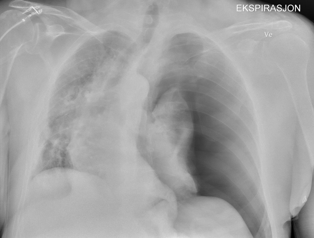 Figur 1 R&oslash;ntgenbildet viser overtrykkspneumothorax p&aring; venstre side med overskyting av mediastinum, trakea og hjertet mot&hellip;