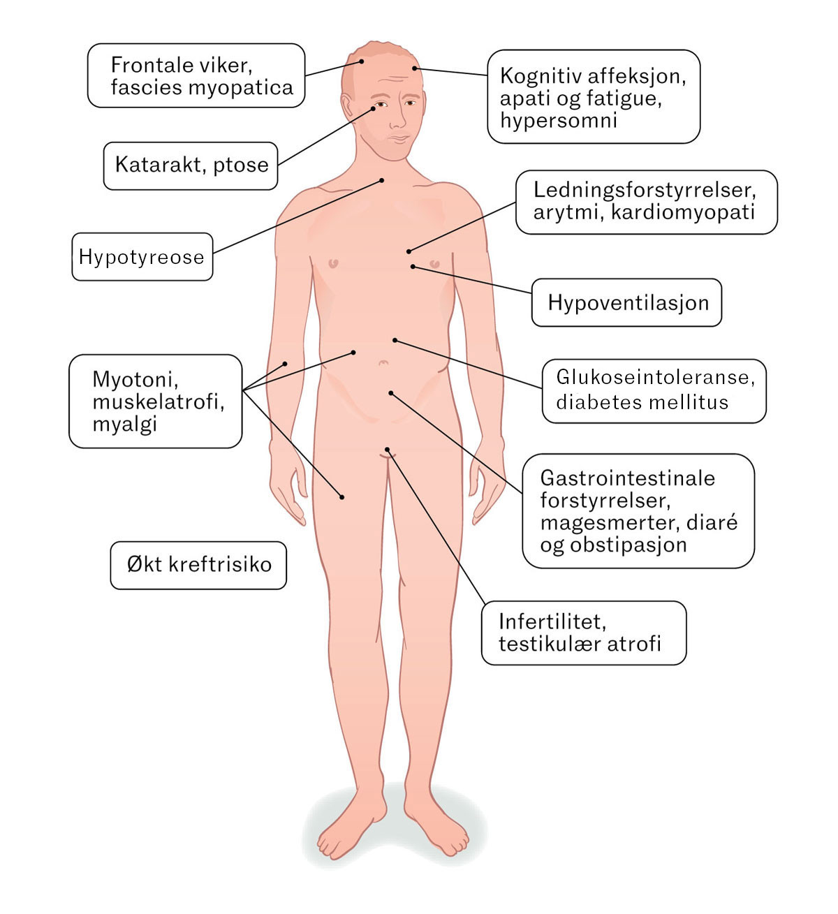 Figur 1 Dystrofia myotonika 1 er en multiorgansykdom. Figuren viser organsystemer som kan affiseres.