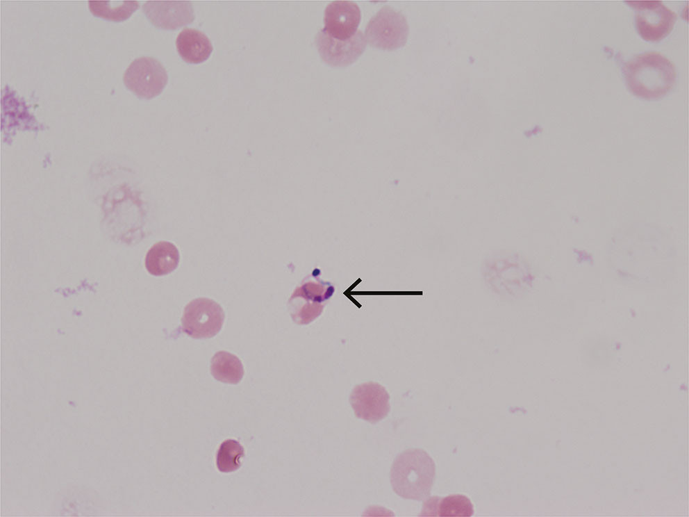 Figur 1 Giemsafarget utstryk av spinalv&aelig;ske hos pasient med Chagas-encefalitt viser Trypanosoma cruzi-trypomastigot.
