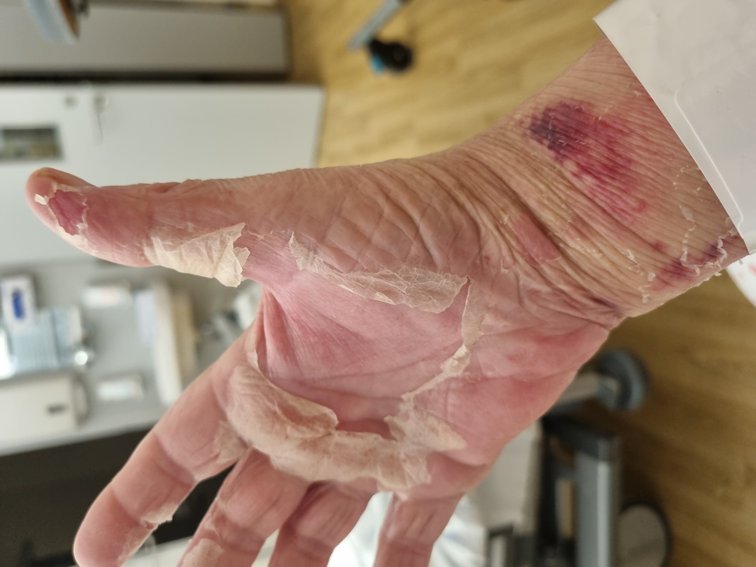 Figure 1 Desquamation of the palm