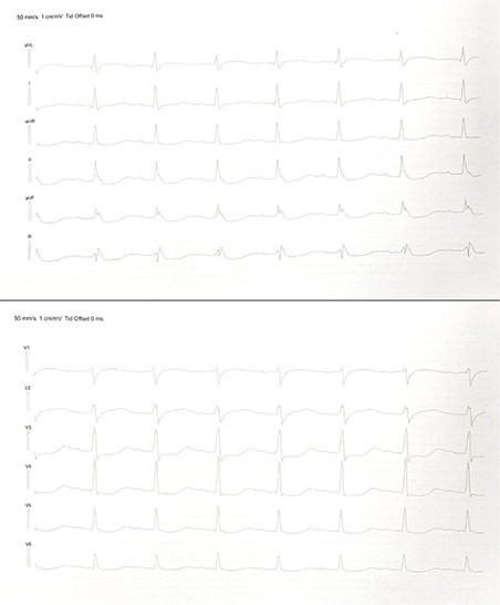 Figur 1 EKG viste sinusrytme med frekvens p&aring; 86/min, ST-depresjoner i avledning II, III, aVF og V3&ndash;V6 og forlenget QT-tid p&aring;&hellip;