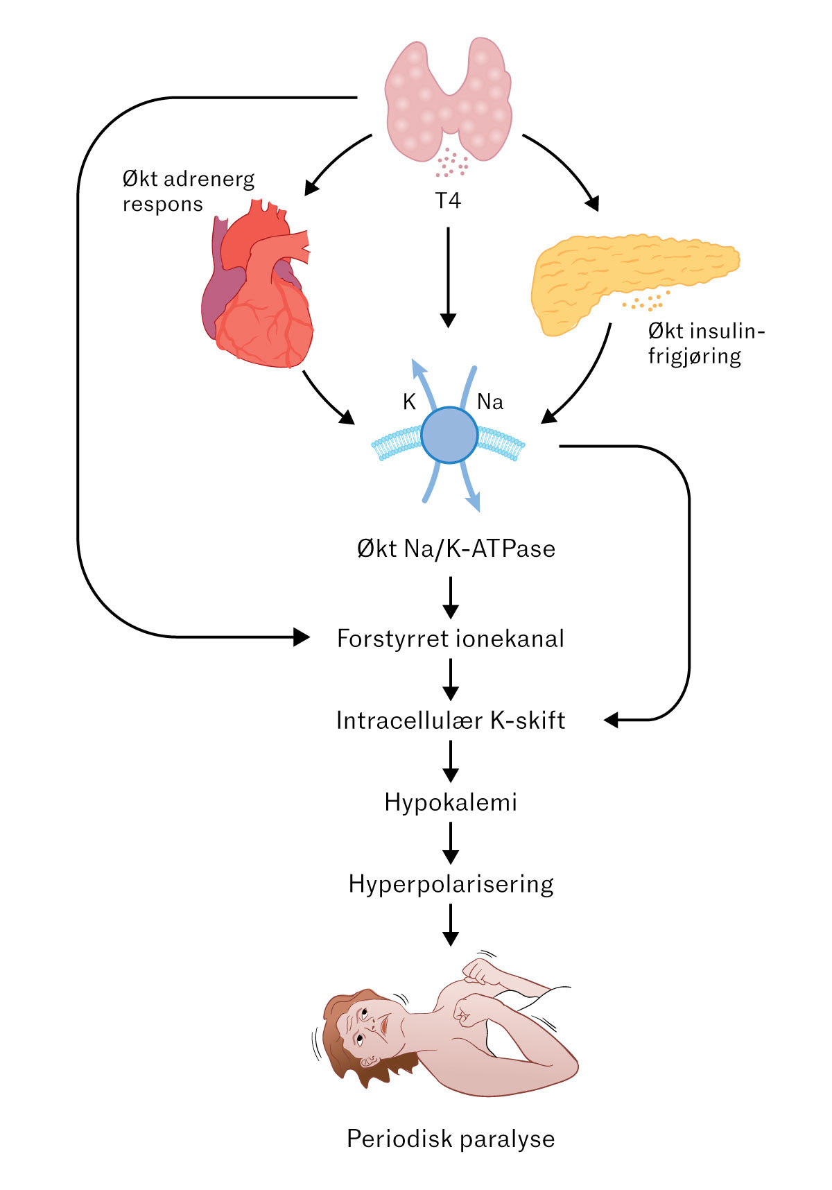Figur 2 Mekanisme for akutt muskelsvakhet ved tyreotoksisk periodisk paralyse (3). Illustrasjonen er basert p&aring; en id&eacute; og&hellip;