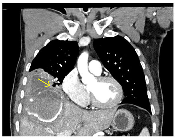 Figur 1 CT-unders&oslash;kelsen viser en ekinokokkcyste i leveren som har brutt gjennom diafragma og inn i h&oslash;yre lunges under- og&hellip;