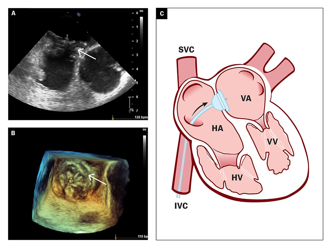 Figur 4 To- og tredimensjonal trans&oslash;sofageal ekkokardiografi (a&ndash;b) viser resultat etter lukking av &aring;pentst&aring;ende foramen&hellip;