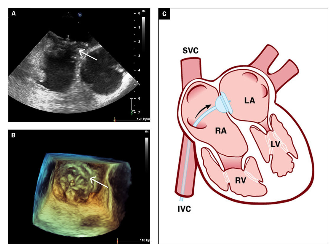 Figure 4 2D and 3D transoesophageal echocardiograms (a&ndash;b) show the outcome after closure of patent foramen ovale with a 30&hellip;