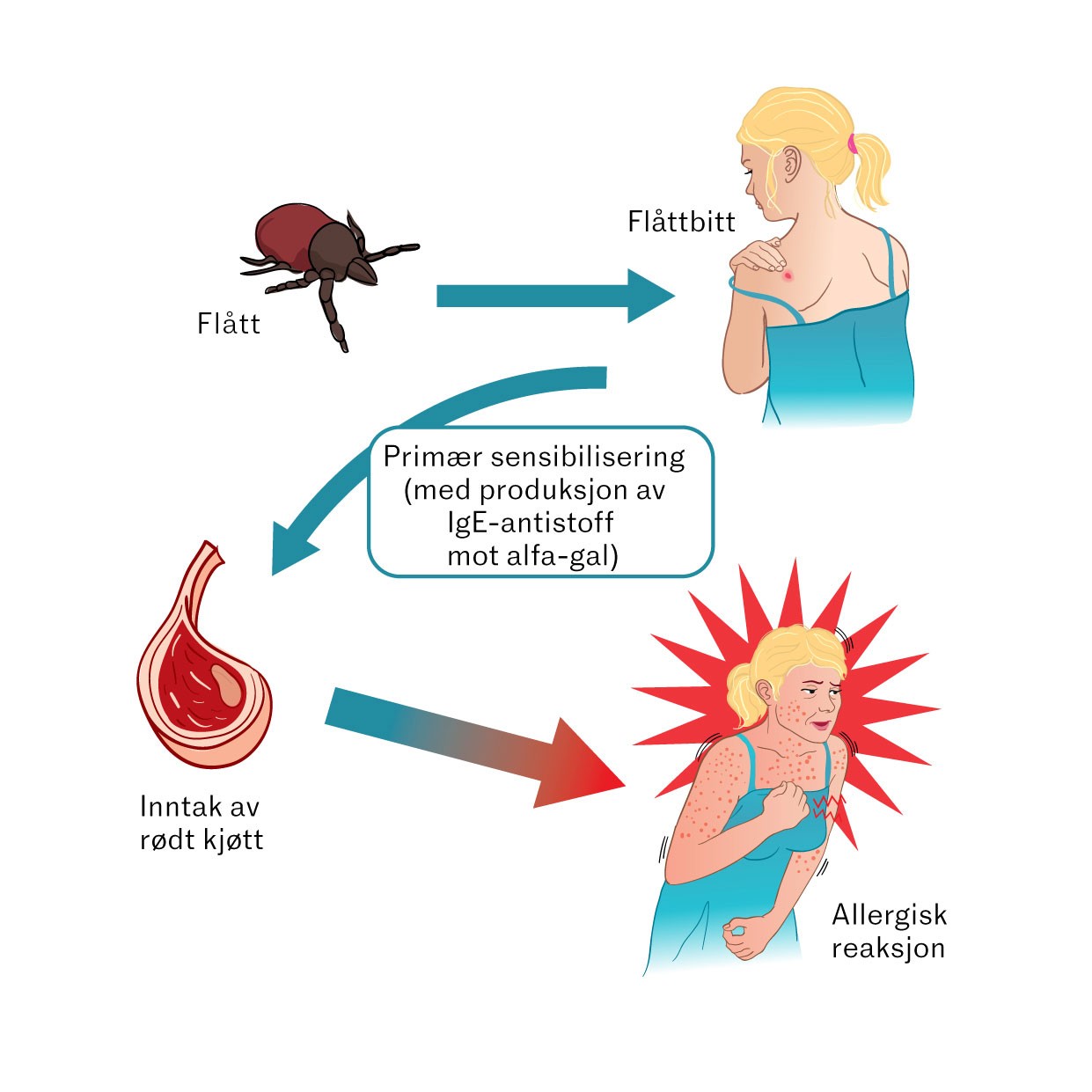 Figur 1 Den prim&aelig;re sensibiliseringen skjer ved fl&aring;ttbitt n&aring;r fl&aring;ttens spytt, som inneholder alfa-gal, blir overf&oslash;rt til&hellip;