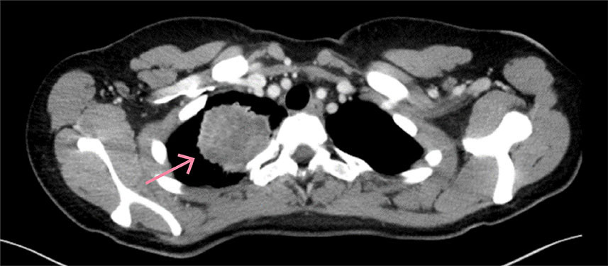 Figur 2 CT toraks. Tumor i h&oslash;yre overlapp.