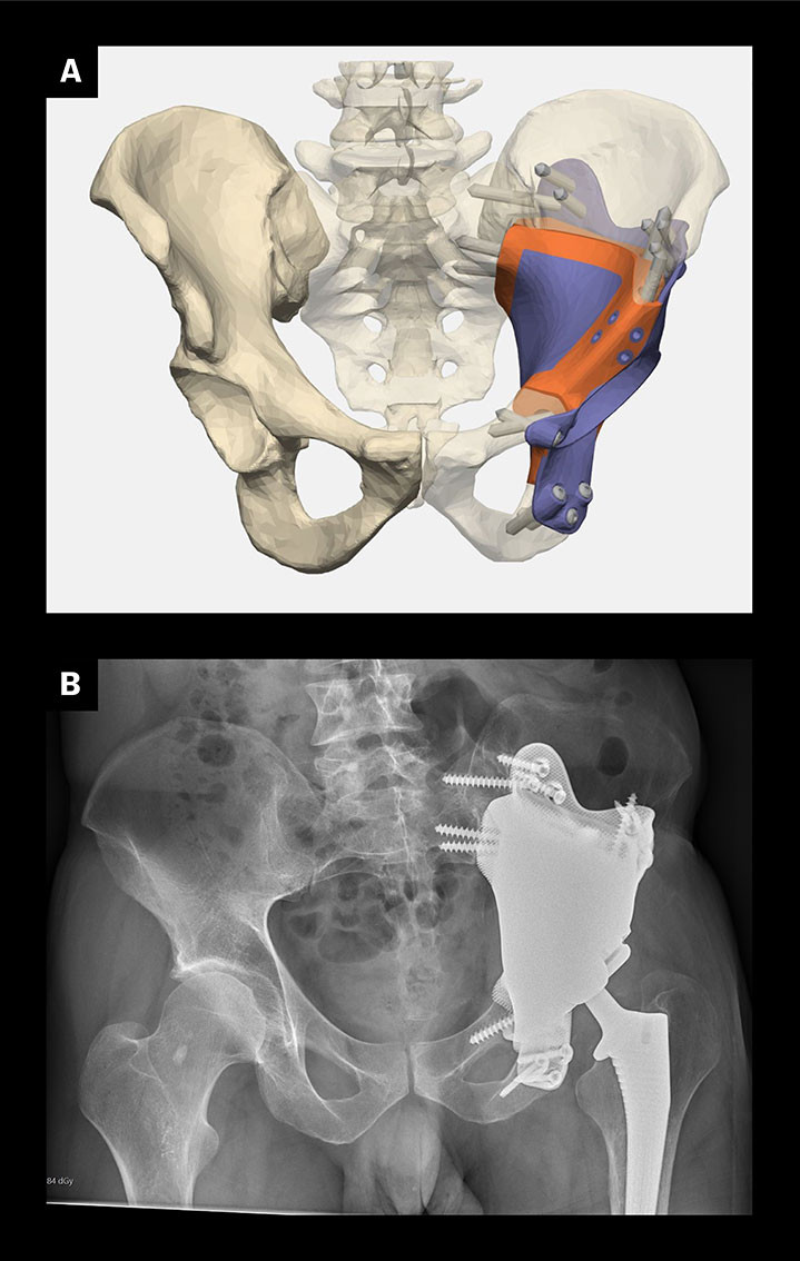 Figure 3 a) Computer-aided 3D reconstruction after removal of a bone sarcoma in the acetabulum. 3D printed titanium&hellip;