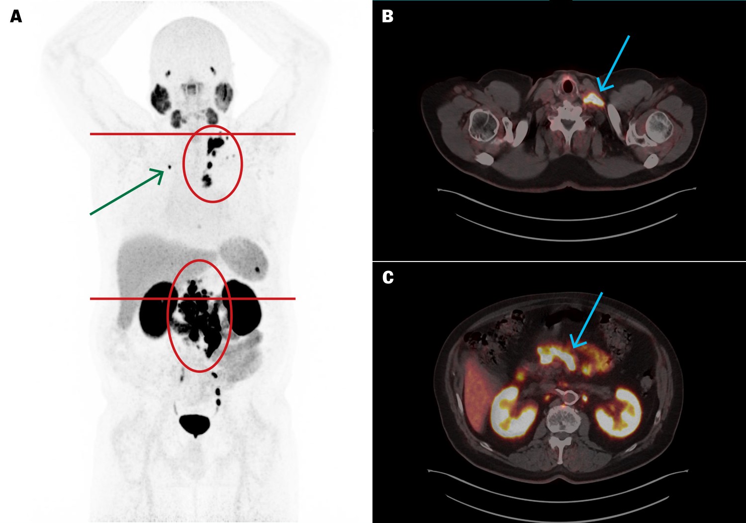 Figur 1 [⁶⁸Ga]PSMA-11 PET/CT f&oslash;r behandling med [&sup1;⁷⁷Lu]PSMA-617 viste h&oslash;yt opptak i spredte metastatiske lymfeknuter i&hellip;