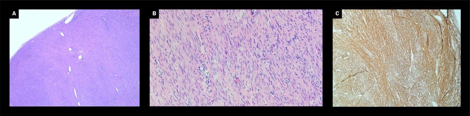 Figure 2 Microscopic view of fascicles of spindle-shaped cells with eosinophilic cytoplasma. a) Haematoxylin-eosin,&hellip;