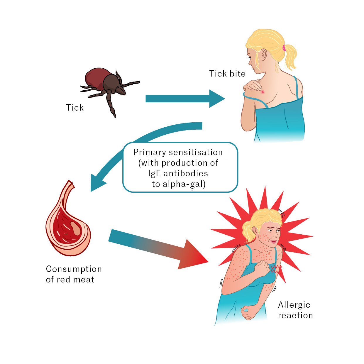 Figure 1 Primary sensitisation occurs during tick bites when the tick's saliva, which contains alpha-gal, is transferred to&hellip;