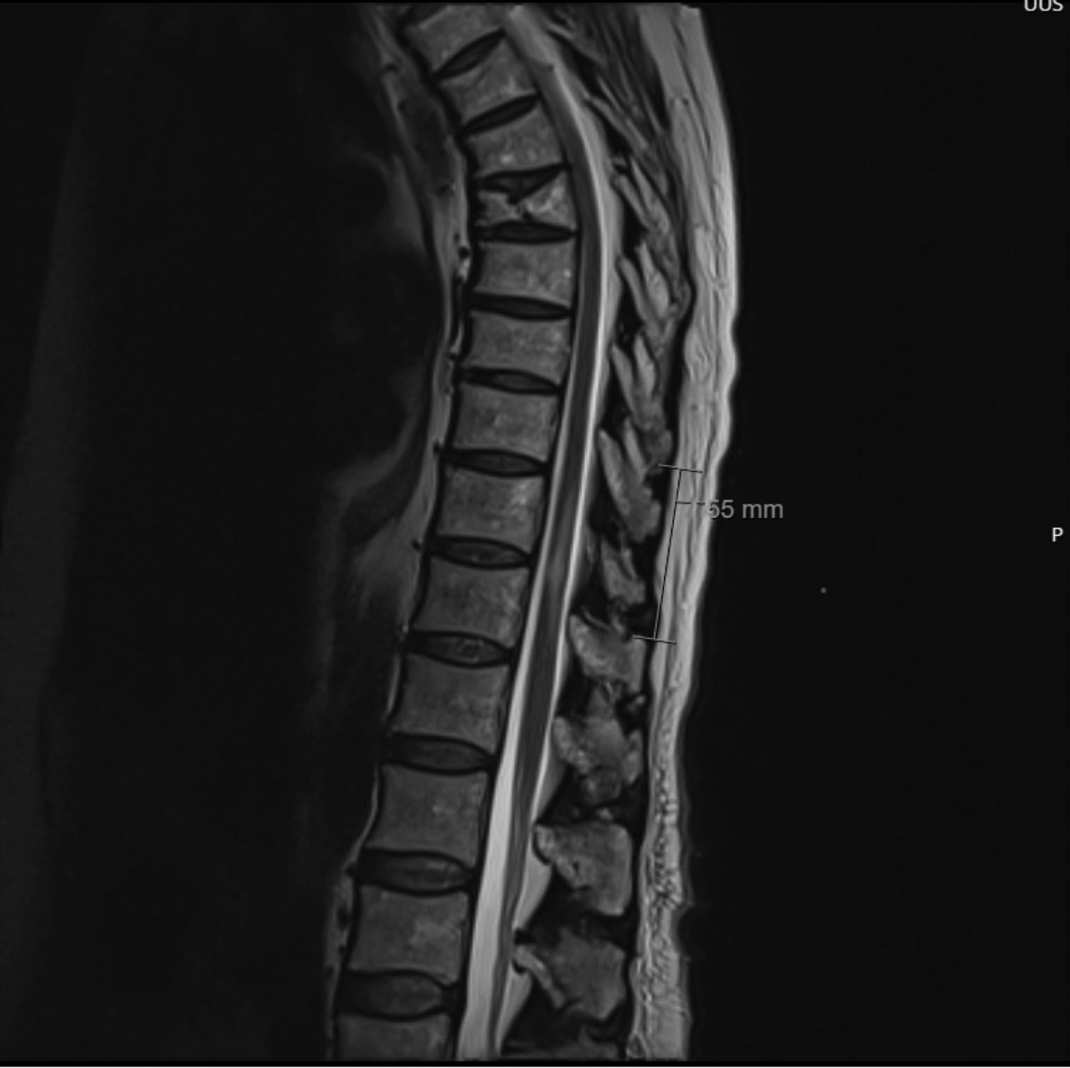 Figur 1 T2-vektet MR-bilde. Det foreligger T2-h&oslash;ysignalforandringer i medulla spinalis i niv&aring; med TH11&ndash;TH12. Kraniokaudal&hellip;