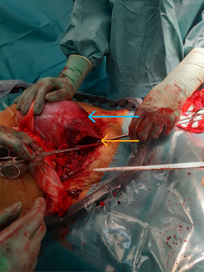 Figur 2 Peroperativt bilde som viser uterus (bl&aring; pil) med totalruptur p&aring; h&oslash;yre side (gul pil).