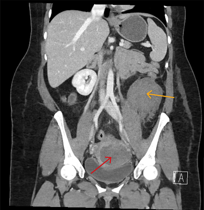 Figur 3 CT abdomen/bekken med kontrast i arteriell fase som viser hematom i cervix (r&oslash;d pil) og venstresidig&hellip;