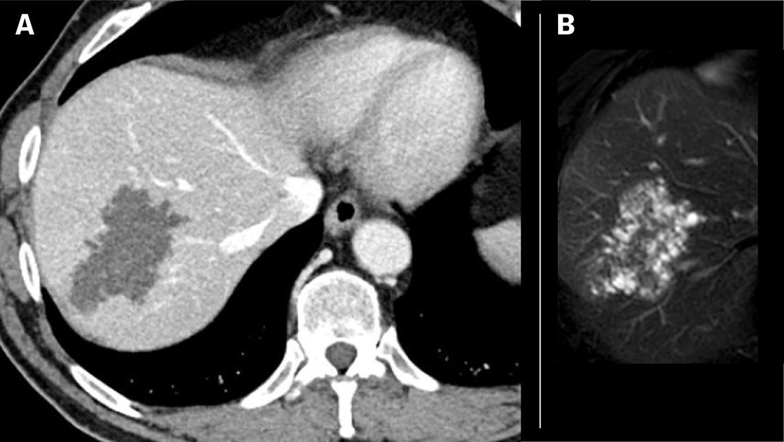 Figur 3 Pasient med alveol&aelig;r ekinokokkose (pasient 2). a) CT med kontrastv&aelig;ske viser en velavgrenset lavattenuerende&hellip;
