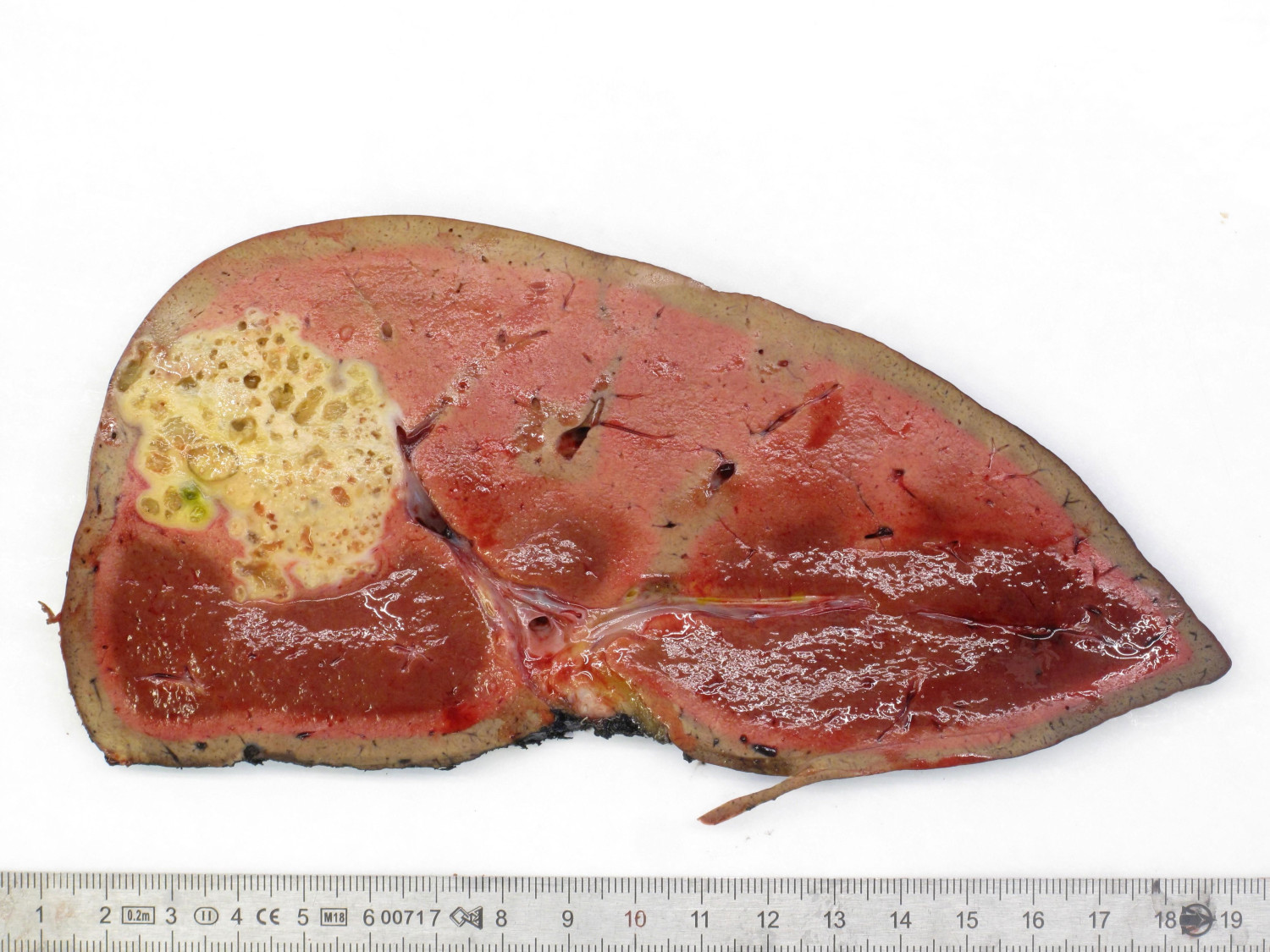 Figur 4 Operasjonspreparat med stor multicystisk tumor i leversegment 7 (pasient 2).