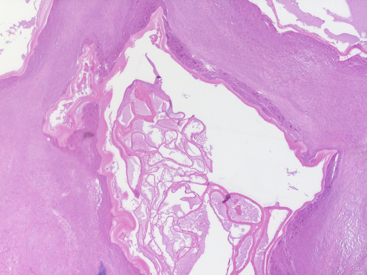 Figur 5 Histologisk unders&oslash;kelse av operasjonspreparat viser cyster med laminerte membraner omgitt av fibrose (pasient 2).