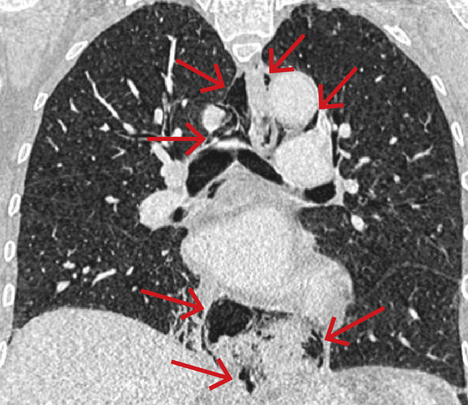 Figur 1 CT toraks med intraven&oslash;s kontrast ved innkomst (koronalt snitt) viste pneumomediastinum med multiple&hellip;