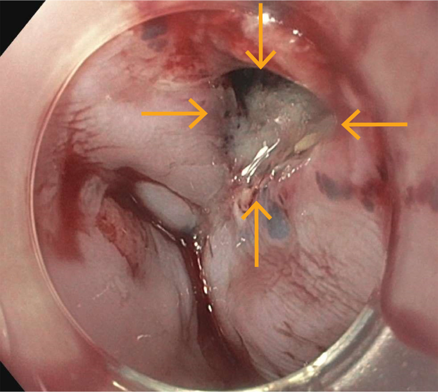 Figur 2 Gastroskopi viste en vel 5&nbsp;mm stor perforasjon i distale &oslash;sofagus (piler).