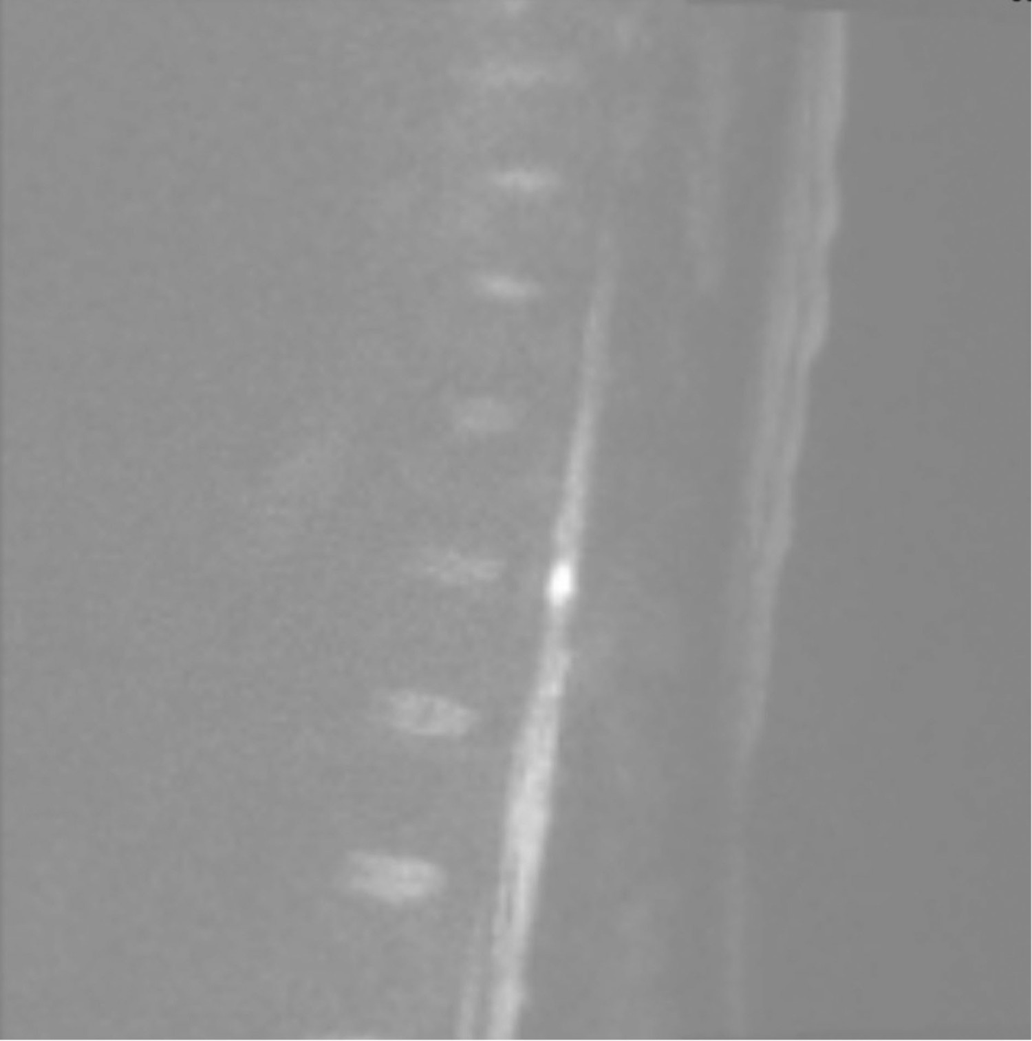 Figure 2 Diffusion-weighted MRI image shows hyperintensity at the Th11&ndash;Th12 levels, consistent with myelitis or stroke. The&hellip;