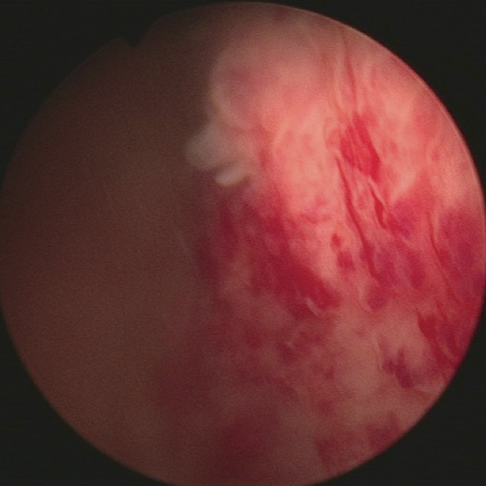 Figur 2 Cystoskopi viser papillomat&oslash;se forandringer i bl&aelig;ren etter metastase fra brystkreft til bl&aelig;re.