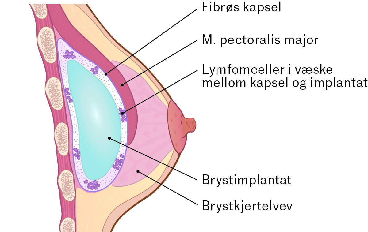 Figur 1 Illustrasjonen viser et bryst med et implantat under den store brystmuskelen og brystimplantat-assosiert anaplastisk&hellip;
