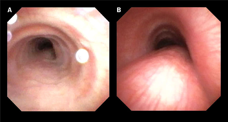Figur 1 Bronkoskopibilder ved tidal pust fra et 15&nbsp;&aring;r gammelt barn som ble operert for karring som spedbarn. a) bildet til&hellip;
