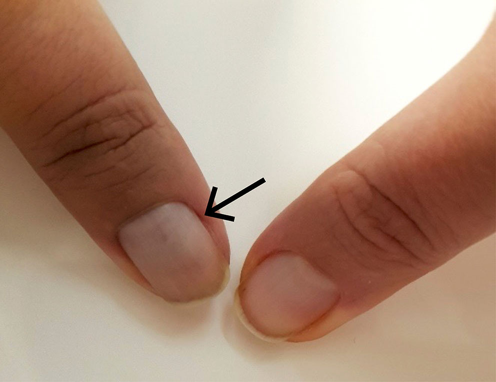 Figur 1 Bl&aring;lig misfarget og lett buet venstre tommelfingernegl (pil) p&aring; grunn av subungual glomustumor, 14&nbsp;&aring;r etter&hellip;