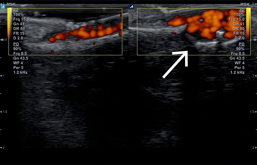 Figur 2 Ultralyd av venstre tommel viste en 6 &times; 6&nbsp;mm lobul&aelig;r struktur med &oslash;kt dopplersignal (pil) under venstre negl (h&oslash;yre&hellip;