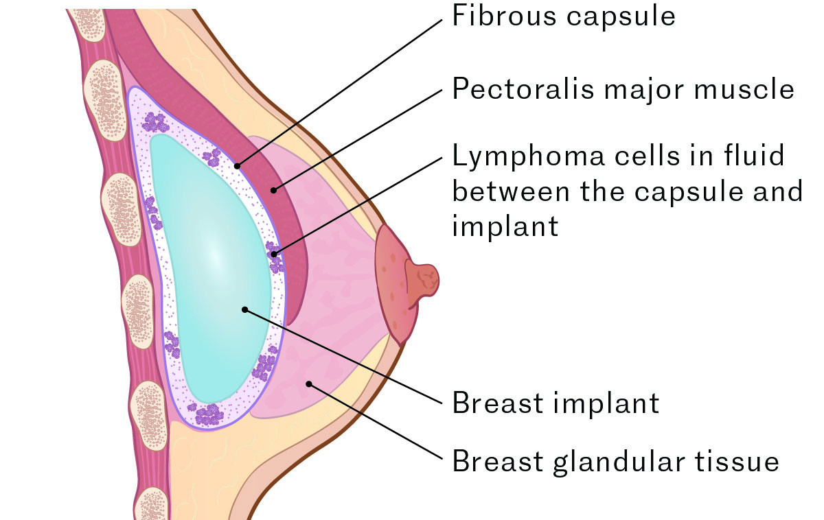 Figure 1 The illustration shows a breast with an implant located under the pectoralis major muscle and BIA-ALCL located in&hellip;