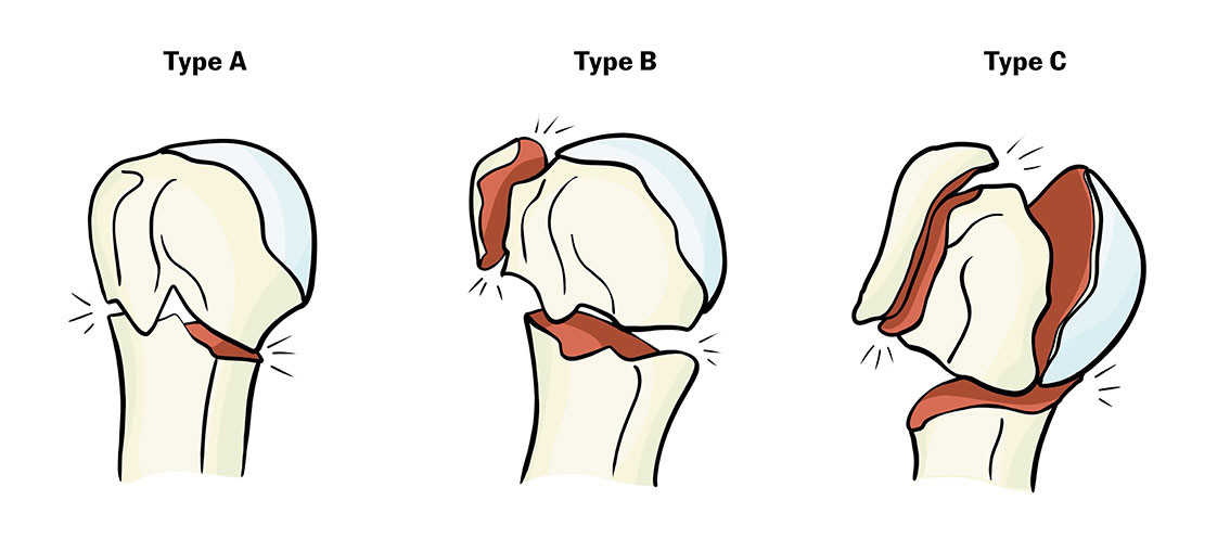 Figur 1 AO Foundation / Orthopaedic Trauma Association (AO/OTA) sin inndeling fra 2018 i tre hovedtyper proksimal&hellip;