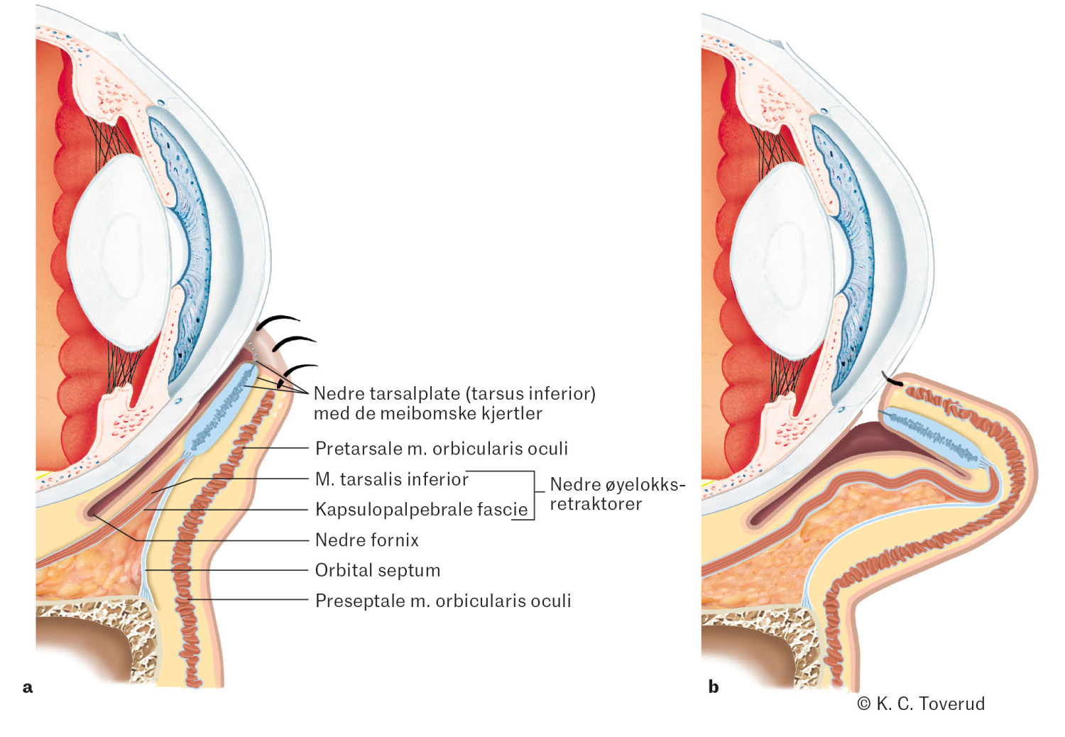 Figur 1 Periorbital anatomi ved aldersrelatert (involusjonell) entropion. Figuren viser hvordan en stabil tarsalplate og&hellip;