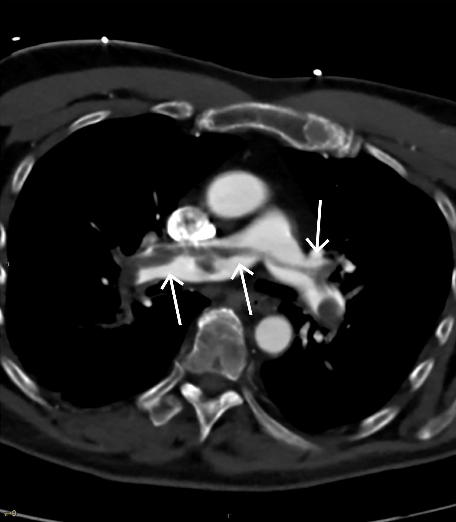 Figur 4 CT-angiografi. Sadelembolusen ses som en m&oslash;rk oppfylling i pulmonalarterien (piler).