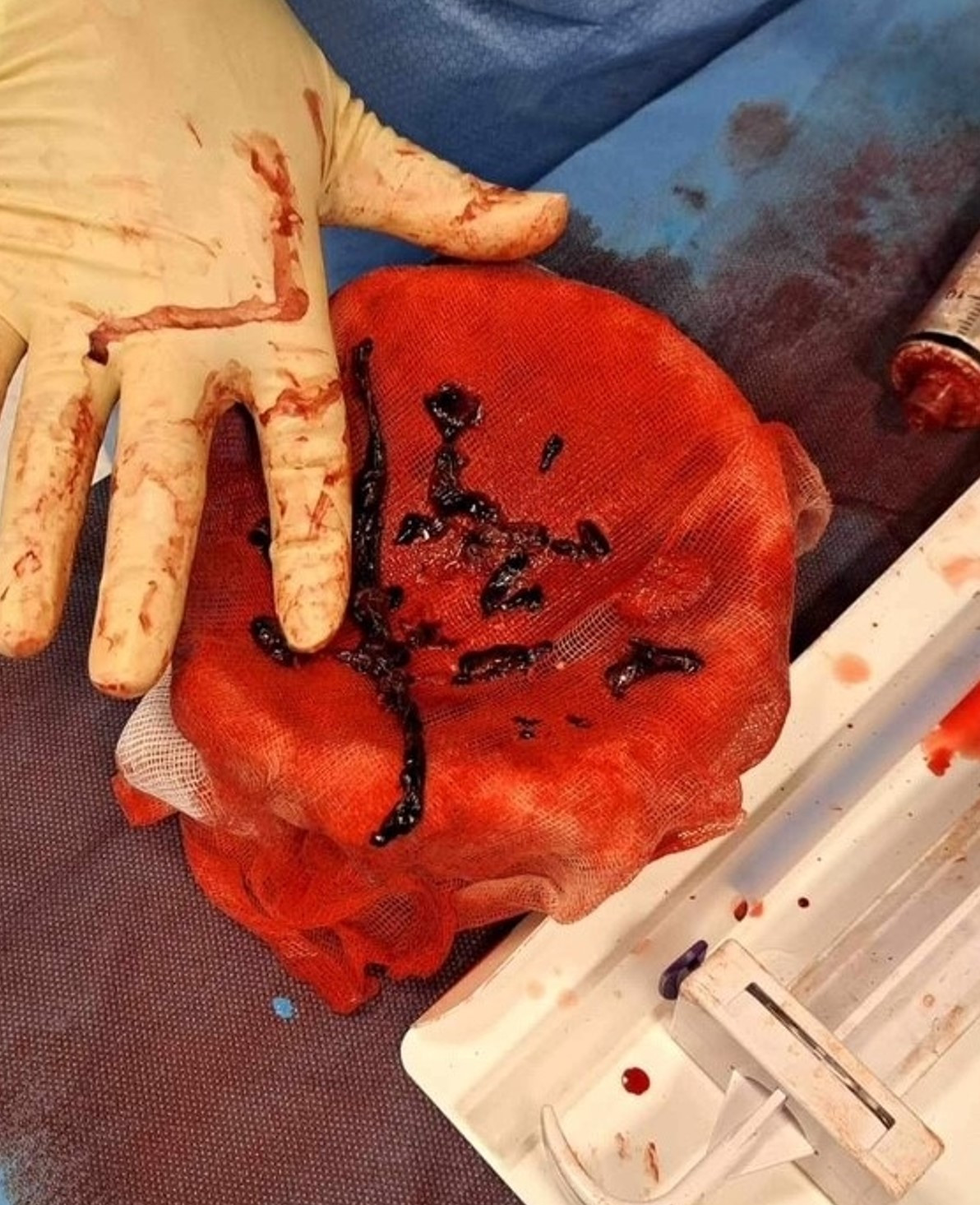 Figur 7 Aspirerte trombemasser.