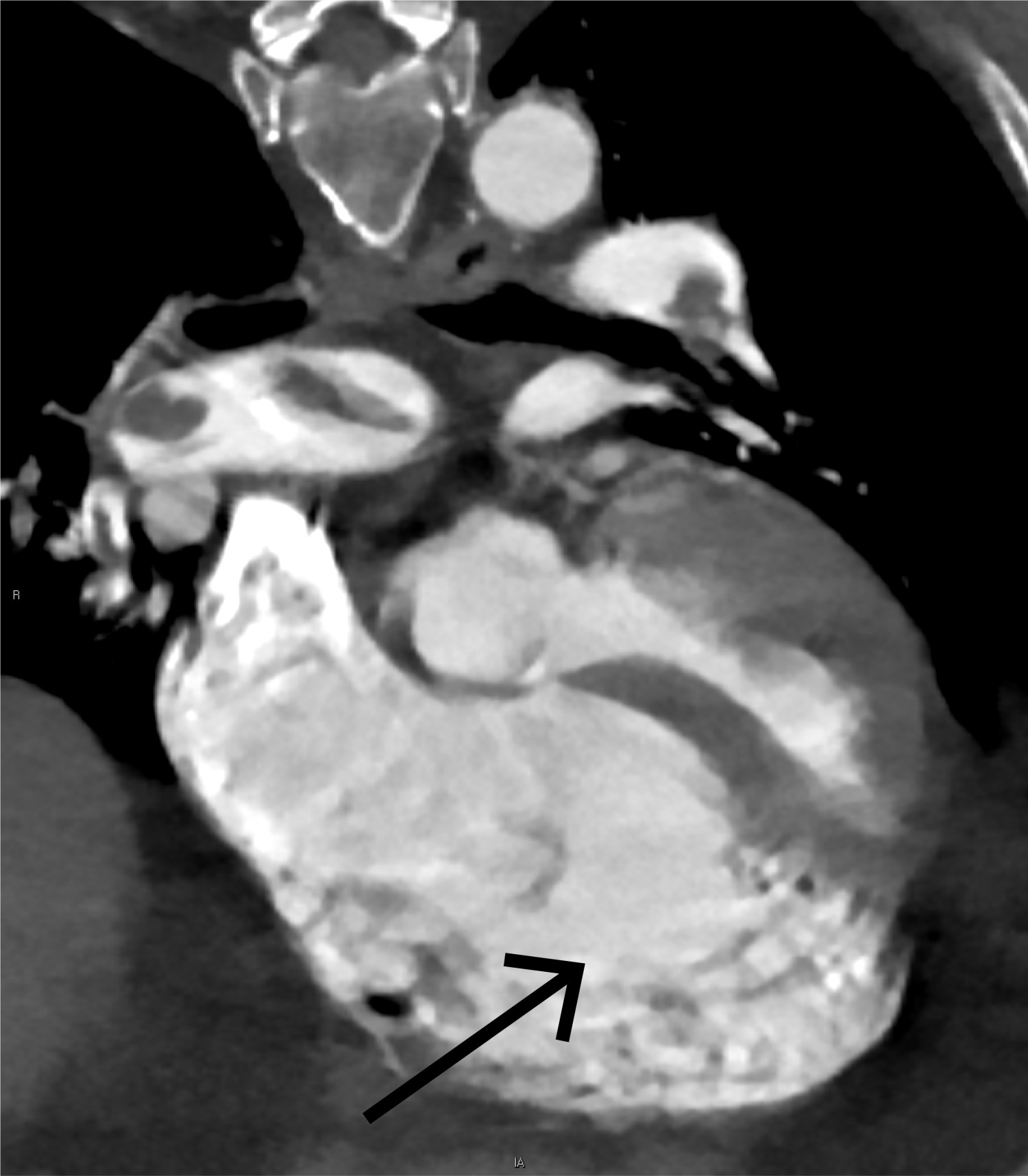 Figur 8 Dilatert h&oslash;yre hjertehalvdel fremstilt p&aring; CT-angiografi.