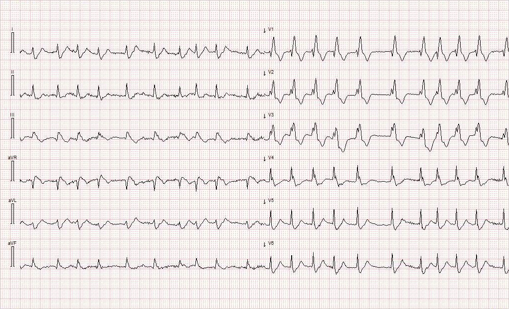 Figur 2 Andre prehospitale EKG 25&nbsp;minutter senere viser atrieflimmer 120/min og utvikling av h&oslash;yre grenblokk, T-inversjon i&hellip;