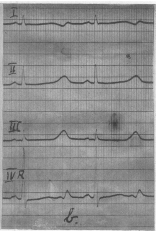 Figur 4 Faksimile fra artikkelen i American Heart Journal i 1957 (1). T-b&oslash;lgen (over &laquo;b&raquo; i bildet) er sterkt forsinket. Den&hellip;