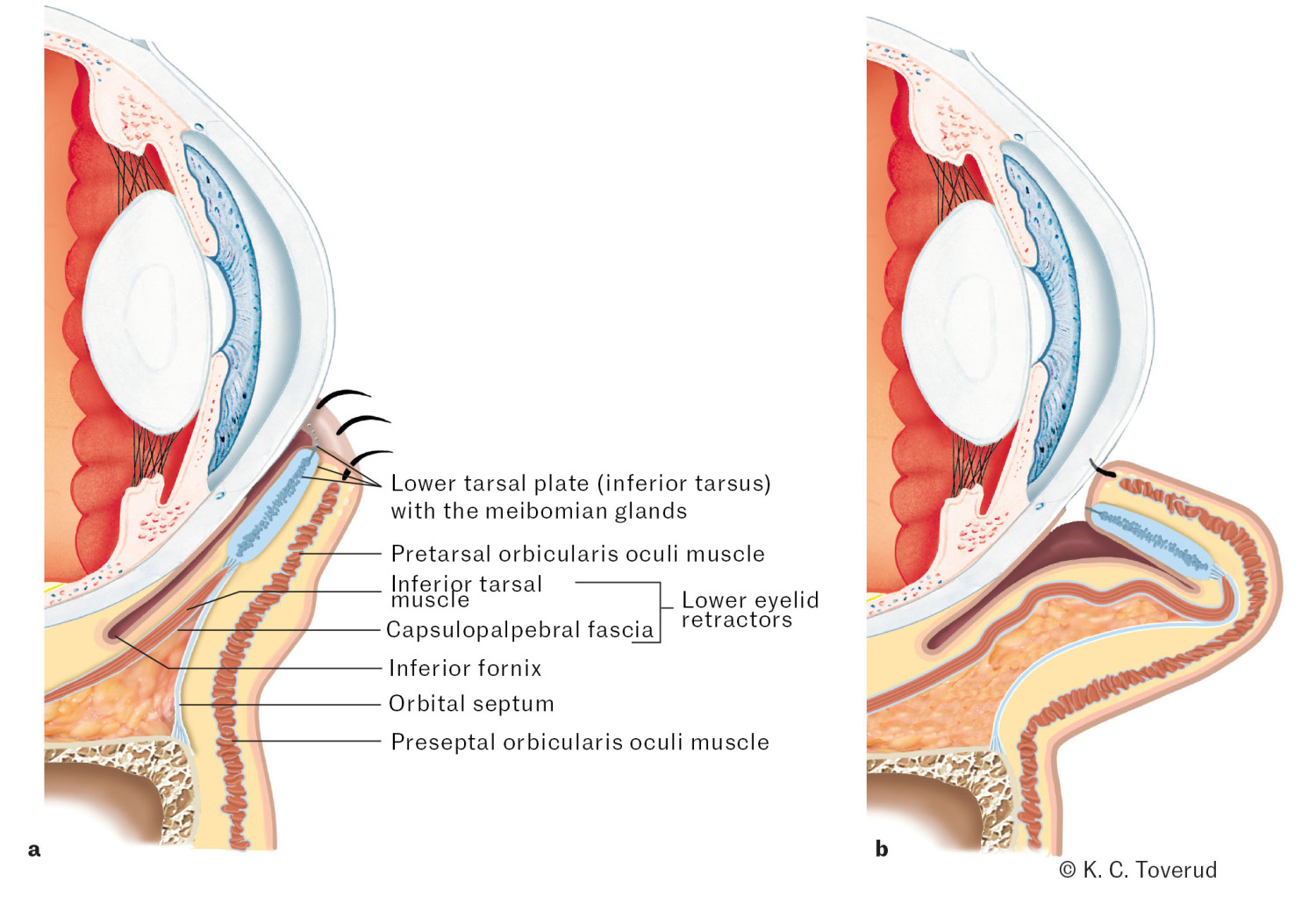 Figure 1 Periorbital anatomy in involutional (age-related) entropion. The figure shows how a stable tarsal plate and tight&hellip;
