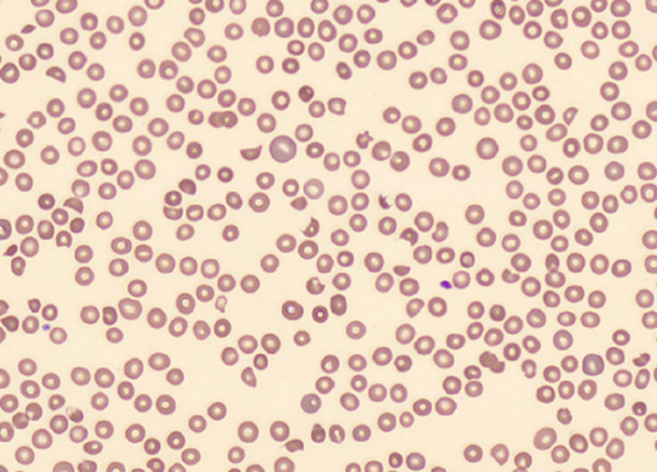 Figur 1 Blodutstryk fra dag 4 viser rikelig med schistocytter, opptil 4&nbsp;%.
