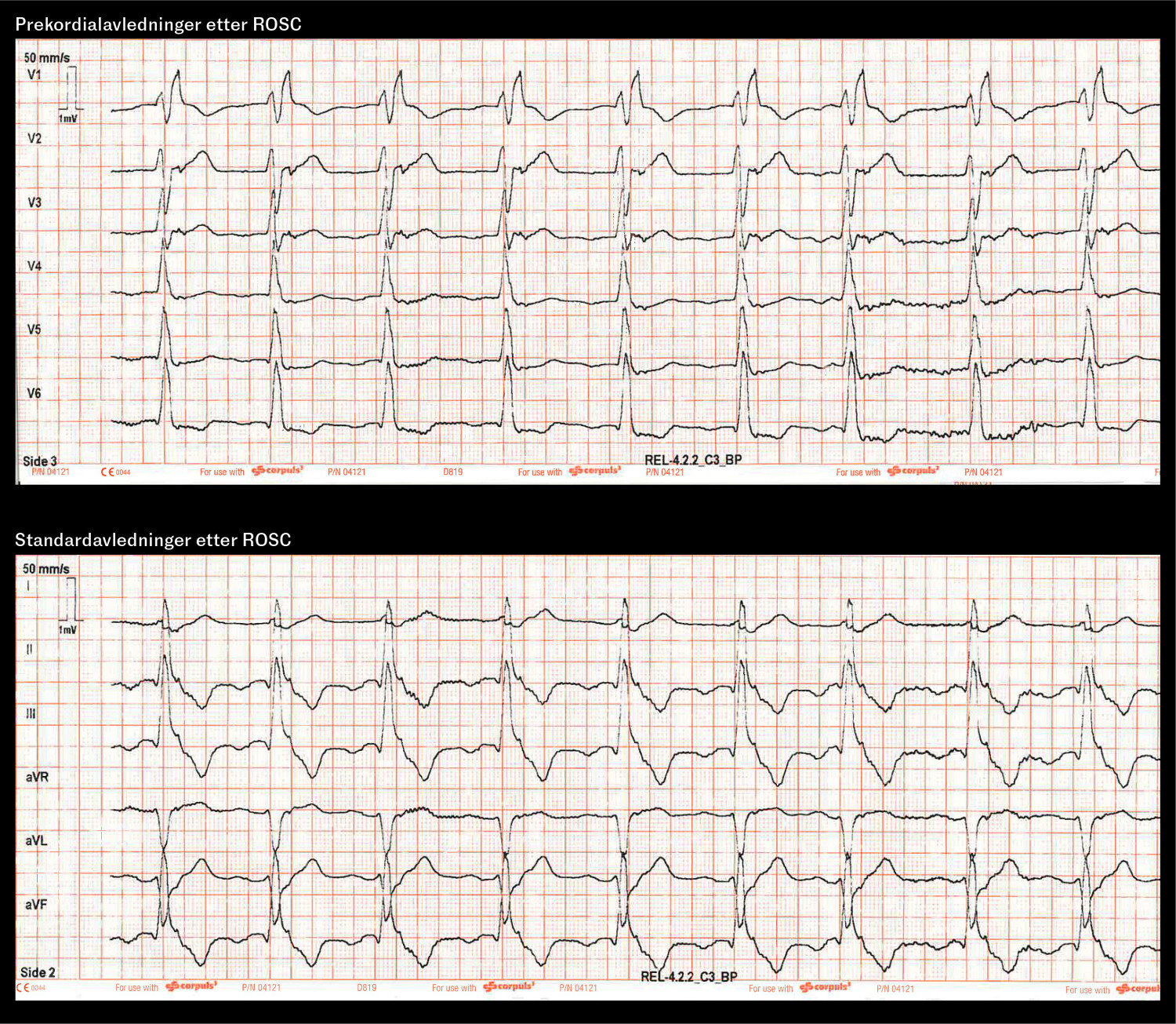 Figur 1 EKG etter autoresuscitering viste sinustakykardi og h&oslash;yre grenblokk.
