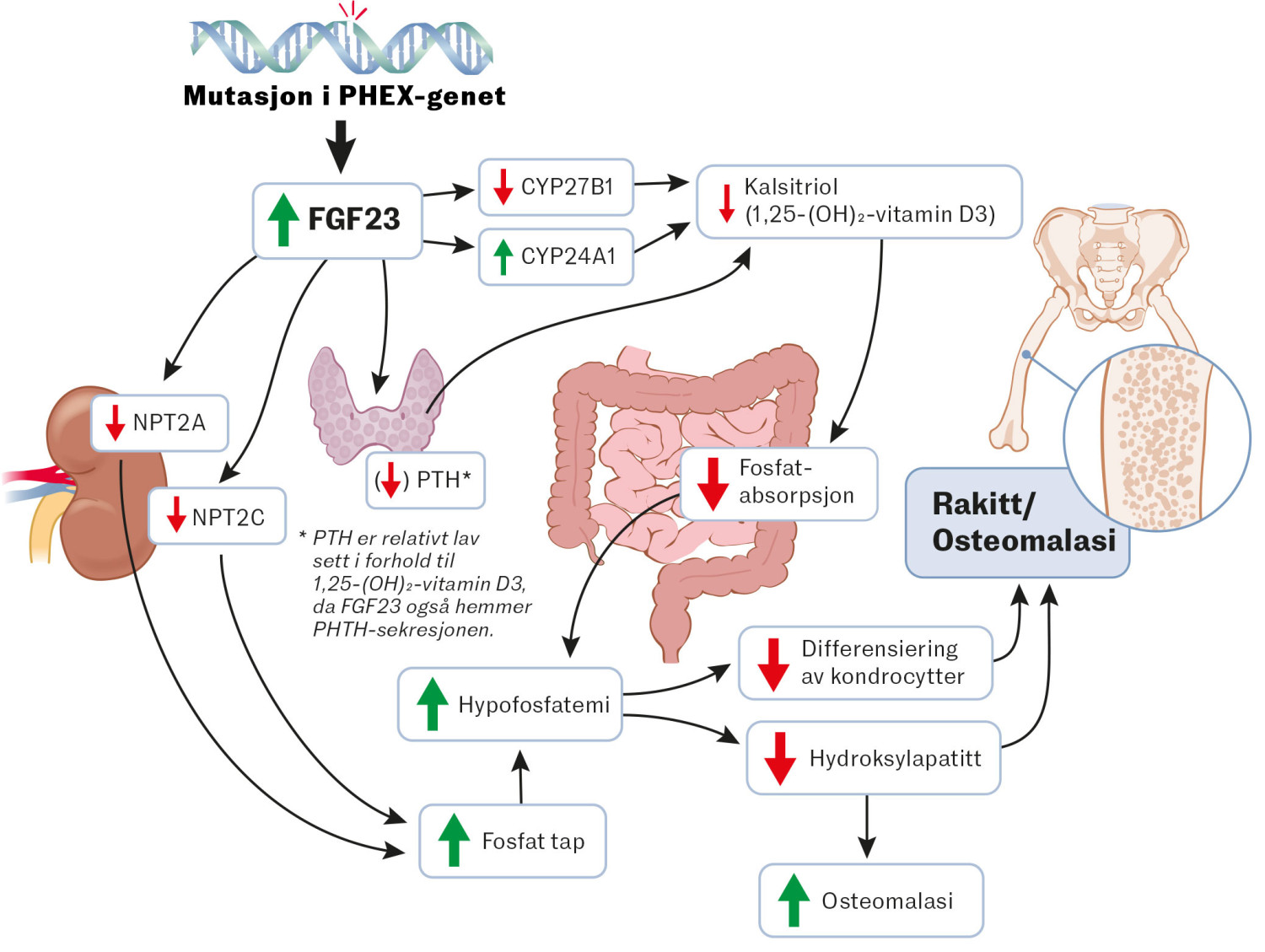 Figur 1 Patogenese ved X-bundet hypofosfatemi: Mutasjoner i PHEX-genet f&oslash;rer til forh&oslash;yet niv&aring; av FGF23. Det gir&hellip;