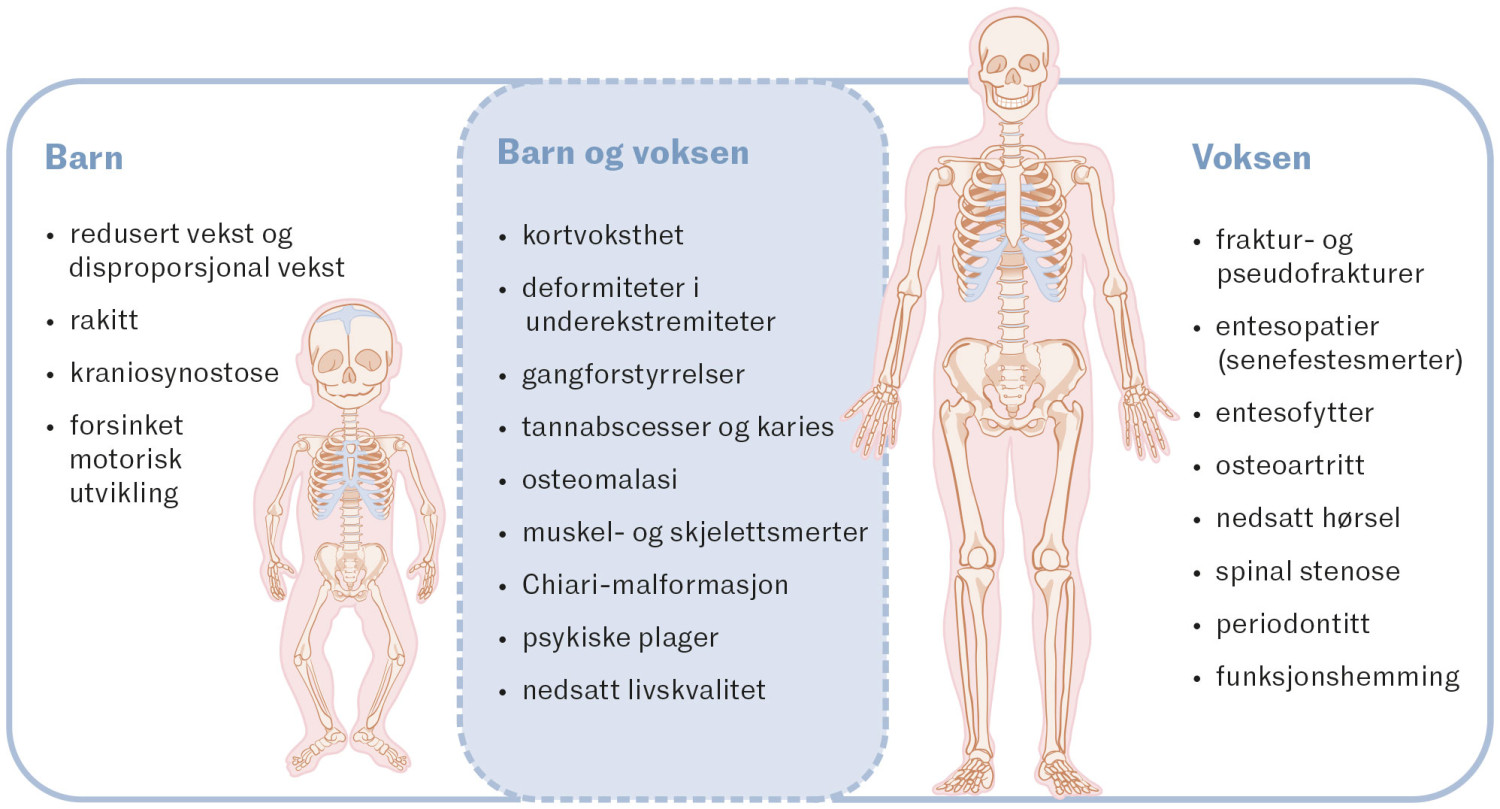 Figur 2 Kliniske manifestasjoner av X-bundet hypofosfatemi (8).