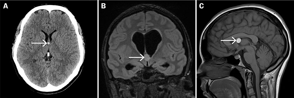 Figur 1 Tre ulike pasienter med kolloidcyster i tredje hjerneventrikkel. a) Aksial CT caput uten kontrastmiddel&hellip;