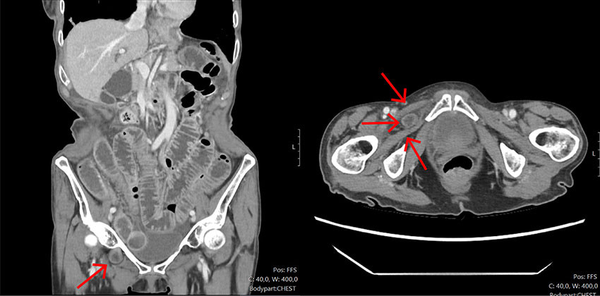 Figur 1 CT abdomen med intraven&oslash;s kontrast (aksialt og koronalt plan) fjerde dag etter f&oslash;rste innleggelse viste dilaterte&hellip;