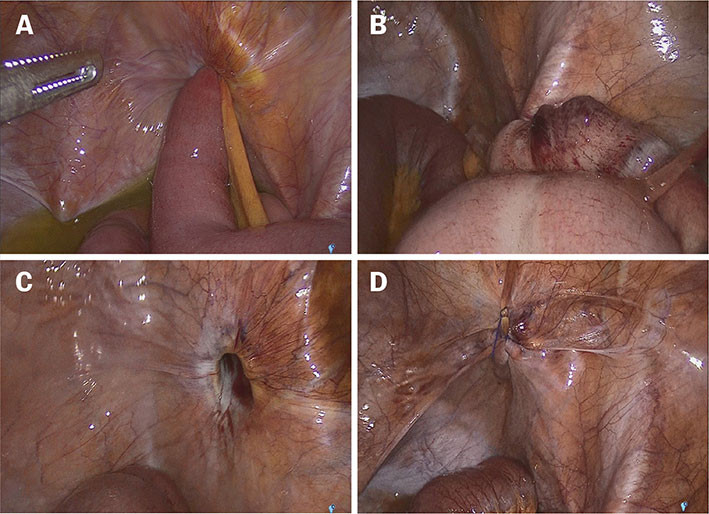 Figur 2a&ndash;d Peroperative bilder fra bukhulen med (a) inneklemt tynntarmsslynge i obturatorkanalen, (b) reponert og viabelt&hellip;