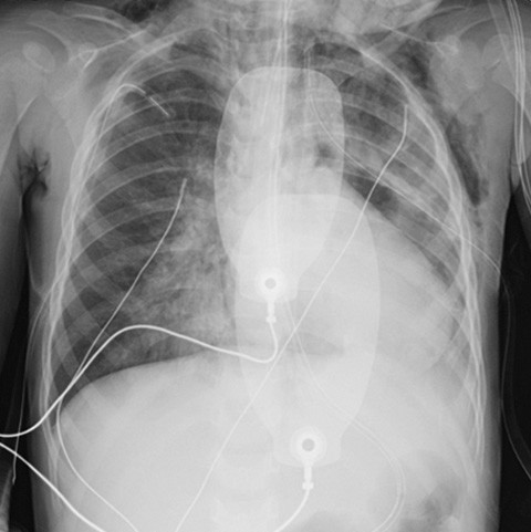 Figur 2 R&oslash;ntgen tatt etter intubasjon og toraksdren p&aring; begge sider. Det var ingen pneumotoraks, men &oslash;kte fortetninger. Det&hellip;