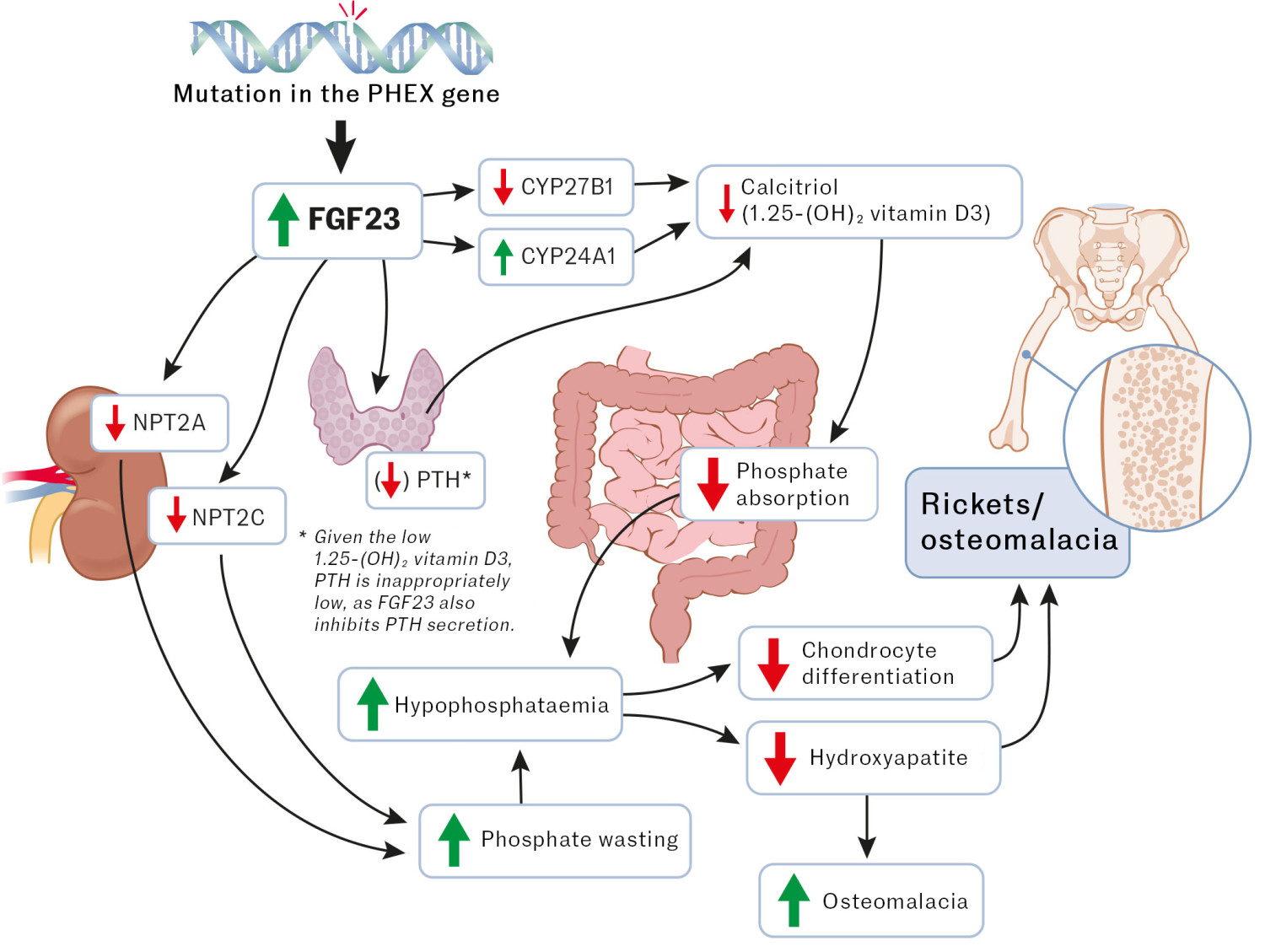 Figure 1 Pathogenesis of X-linked hypophosphatemia: mutations in the PHEX gene lead to elevated FGF23. This results in the&hellip;