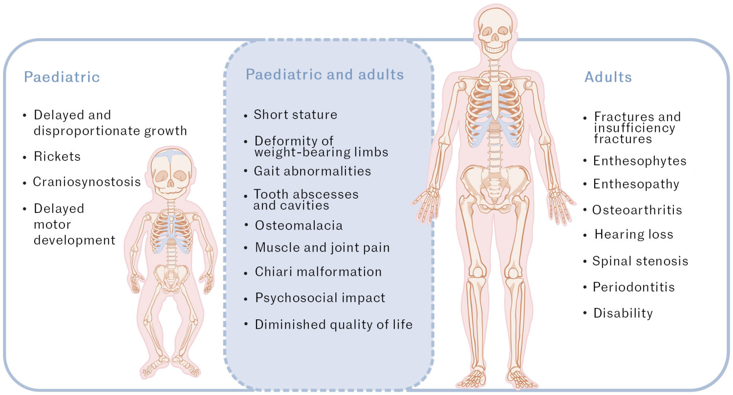 Figure 2 Clinical manifestations of X-linked hypophosphatemia (8)