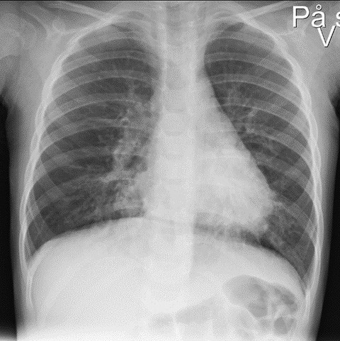 Figure 1 Chest X-ray on admission to hospital showed perihilar opacities.